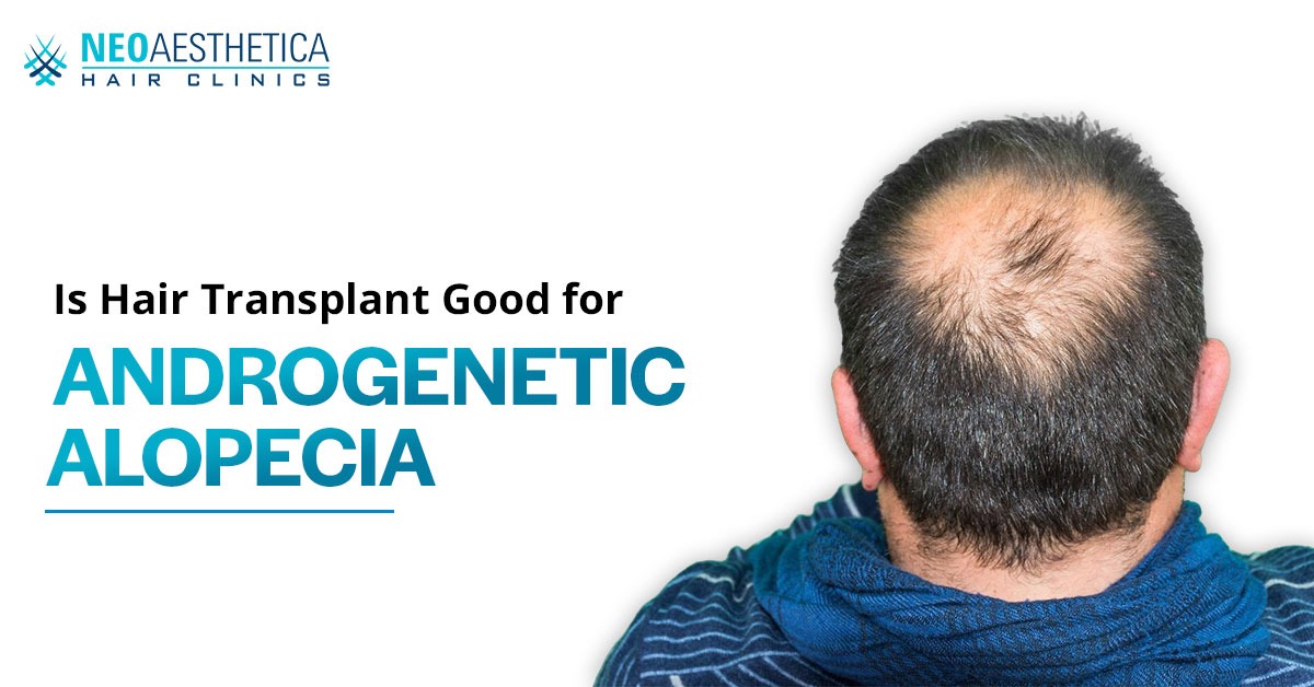 Hair-transplant-for-androgenetic-alopecia